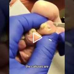 Tackling tough calluses, Pumice Stone