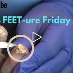 FEET-ure Friday | 85-Year-Old Homeless Man Couldn't Cut His Toenails