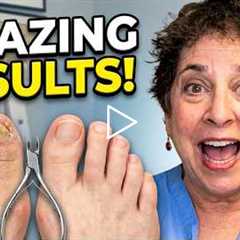 FEET-ure Friday | She Waited 2 YEARS... Look at the Difference! 😲🦶 Thick Toenail Transformation