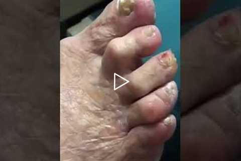 The Final Step Applying Antibiotic Cream