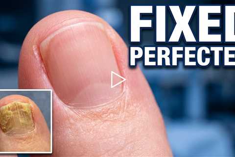 She Was Too Embarrassed to Show Her Feet... Until Now 🦶❤️ | Thick Toenails & Foot Care