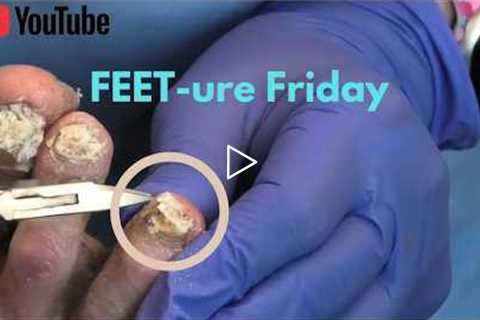 FEET-ure Friday | 85-Year-Old Homeless Man Couldn't Cut His Toenails
